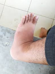 Check 'jari kaki' translations into english. Kaki Bengkak In English