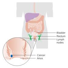 A change in bowel habits, such as diarrhea, constipation, or narrowing of the stool, that lasts for more than a few days a feeling that you need to have a bowel movement that is not relieved by having one rectal bleeding with bright red blood blood in the stool, which might make it look dark brown or black Anal Cancer Wikipedia
