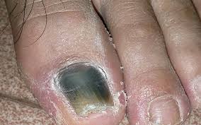 Image result for toe black diabetes