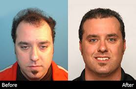 Meet Mark DiStefano and Chris Heinis of DiStefano Hair Restoration Center