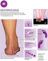Image result for Foot Progression Angle