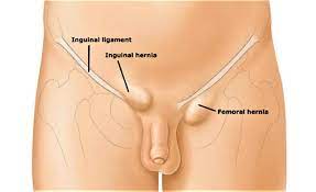 The pubic area of females is loca. Lump In Groin Female And Male Causes And Diagnosis
