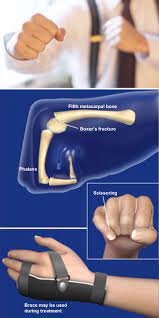 Occasionally it is used to refer to fractures of the 4th metacarpal as well. Diagnosis Treatment Of Boxer S Fracture Injuries Orthopaedic Associates Of Riverside