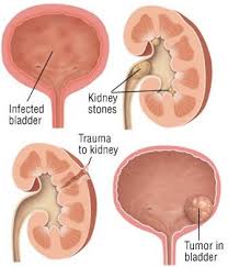 Maybe you would like to learn more about one of these? Hematuria Guide Causes Symptoms And Treatment Options