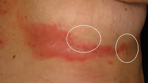 Hvis tilstanden får utvikle seg, blir hudreaksjonen mer intens med sterkere rødfarging, væsking, sårdannelse, sprekkdannelse, oppsmuldring av hud og skjelldannelse. Intertrigo Altmeyers Encyclopedia Department Dermatology