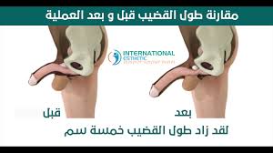 عملية تكبير القضيب في تركيا العضو الذكري International Esthetic إنترناشونال أستاتيك