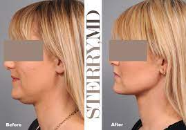 The chin/face wrap should be snug but not too tight. What S Best For Double Chin Removal Plastic Surgery News For New York City From Dr Thomas P Sterry