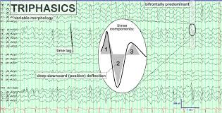 Triphasic Waves Usually Metabolic Disorders Sleep Medicine Metabolic Disorders Study Tools