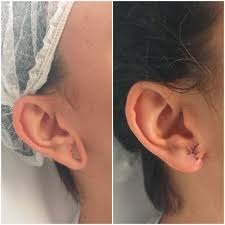We did not find results for: Dilataciones Y Desgarros En El Lobulo De La Oreja Cirugia Plastica Dr Delgado Mora Clinica Medicina Estetica Madrid Cirugia Plastica Esbeltic 14 Agosto 2021