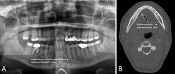 Image result for Sialolithiasis