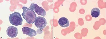 Angioimmunoblastic lymphadenopathy with dysproteinemia is a disorder characterized by an acute onset of generalized. Angioimmunoblastic T Cell Lymphoma With Polyclonal Proliferation Of Plasma Cells In Peripheral Blood And Marrow Semantic Scholar
