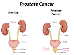 03.09.2021 · inpatient stay and outpatient visit costs. Low Cost Prostate Cancer Treatment In India Health Nigeria