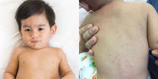 Penyakit chicken pox ini berlaku apabila terdapat jangkitan virus yang dikenali sebagai varicella. Campak Pada Bayi Boleh Dijangkiti Ini Perkara Penting Ibu Perlu Buat Theasianparent Malaysia