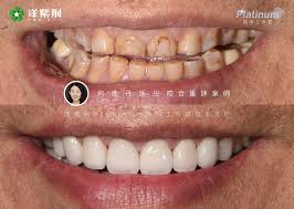Image result for Occlusal
