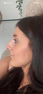 Before and After picture