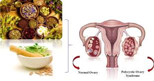 Polycystic ovarian syndrome (pcos), recently referred also as hyperandrogenic anovulation, is a chronic anovulation syndrome associated with androgen excess. A Review On Role Of Medicinal Plants In Polycystic Ovarian Syndrome Pathophysiology Neuroendocrine Signaling Therapeutic Status And Future Prospects Sciencedirect