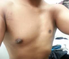 Poland syndrome is a disorder in which affected individuals are born with missing or underdeveloped muscles on one side of the body, resulting in abnormalities that can affect the chest, shoulder, arm, and hand. Poland Syndrome Consultant360