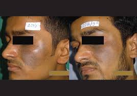 Indian Journal Of Dermatology Venereology And Leprology 1064 Nm Q Switched Nd Yag Laser Treatment Of Nevus Of Ota An Indian Open Label Prospective Study Of 50 Patients