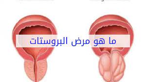تجربتي مع تدليك البروستاتا وفوائد التدليك – مميز