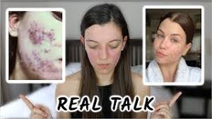La jeune lyonnaise explique souffrir d'acné hormonale depuis plus de 5 ans. Enjoyphoenix Et L Acne I Ma Reaction Youtube