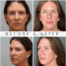 Skip the windblown look and opt for a natural transformation! ✨ Check out  these stunning before and after photos of a deep plane facelift and neck  lift with fat transfer. Dr. Chelsea