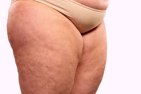 The only way is to add in strength training to reduce the appearance of cellulite. Why Is My Fat Cellulite Painful The Cellulite Experts Lipotherapeia London