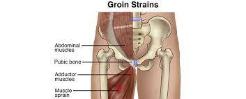 The groin muscles are a group of muscles situated high on the leg in the inner thigh. Groin Strain Treatment California Chiropractic Dubai