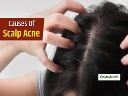 Acne, like hair loss, is often worsened and even caused by stress , but the stress is strongly interlinked with hormonal balance. Do You Have Acne On Scalp Know The 5 Main Causes Of Scalp Acne Breakouts