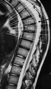 Scheuermann's disease (also called scheuermann's kyphosis) is a condition that starts in childhood. Scheuermann Disease Statpearls Ncbi Bookshelf