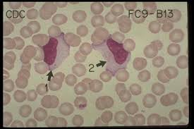 A mononucleosis infectiosa (infectious mononucleosis: Mononucleosis