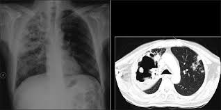 Pin On Thorax