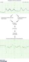 Image result for Delayed Transition from Fetal Circulation