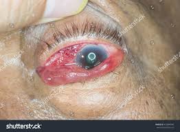 Image result for Proptosis