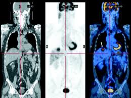 You can see how to get to st. Whole Body Pet Ct For Initial Staging Of Choroidal Melanoma British Journal Of Ophthalmology