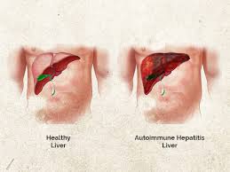 Autoimmune hepatitis can lead to cirrhosis and liver failure. World Hepatitis Day 2019 Autoimmune Hepatitis Its Causes Symptoms Diagnosis Treatment Boldsky Com