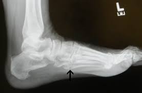 This information will guide you through the next 6 weeks of your rehabilitation. 5th Metatarsal Avulsion Fracture Footeducation