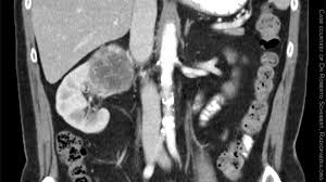 Blood tests can also give them good information. Why Did This Cancer Metastasize To The Pancreas Medpage Today