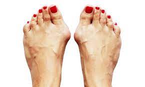 Ratgeber Was Hilft Bei Einem Hallux Valgus Kleinezeitung At