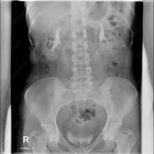 Image result for Intravenous Pyelogram