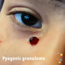 We did not find results for: Pyogenic Granuloma Skin Deep