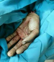 Ringan seperti bulu, tak ada apa apa di dalamnya, orang yang paling tegap dan kuat tak boleh menahannya dalam 593. Klangkampunghalamanku Apa Perlu Buat Jika Lihat Atau Berhadapan Kes Jari Anggota Badan Terputus Kerana Kemalangan Saya Pernah Baca Cerita Seorang Rakan Yang Bekerja Di Jabatan Kecemasan Waktu Syif Yang Tenang Bergegar Bila