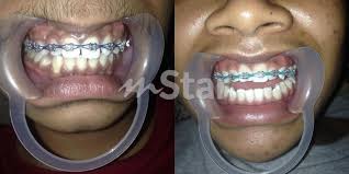 Jika dipasang di klinik kerajaan, berapakah harga pendakap gigi yang akan dikenakan? Gadis Tawar Braces Murah Promosi Akhir Tahun Tapi Apabila Dr Amalina Bersuara Terus Padam Tweet Viral Mstar