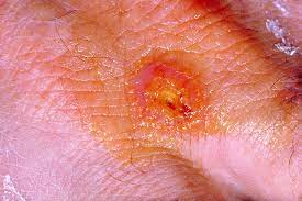 Other articles where francisella tularensis is discussed: Francisella Tularensis Bcm Hgsc