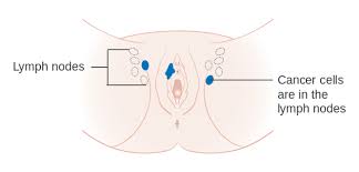 Offene stelle unter großer schamlippe. Vulvakarzinom Vulvakrebs Definition Symptome Therapie