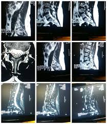 Mri Lumbar Sacral Views Of Arachnoiditis Crps Spinal Fusion Chronic