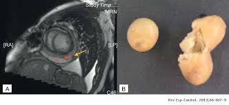 Etiology of pericarditis in a prospective cohort of 1162 cases. Constrictive Infectious Pericarditis Caused By Propionibacterium Acnes Revista Espanola De Cardiologia