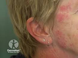 Image result for Connective Tissue Disorder