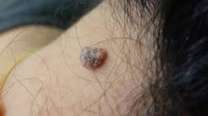 These melanoma pictures can help you determine what to look for. Skin Cancer Moles Treatment In Huntington Moles Versus Skin Cancer