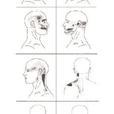 Trigger Point Study Consort Flow Chart Download