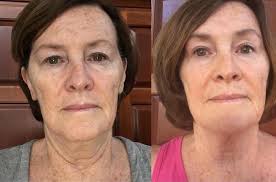 🚨TODAY I ADDED MY COLLAGEN TO THE TEA OF DAY... SO GOOD... 🛑🛑BENEFITS OF  COLLAGEN 🛑🛑 *Improves health of the skin & hair. *Reduces joint pain &  degeneration. *Helps heal leaky gut. *